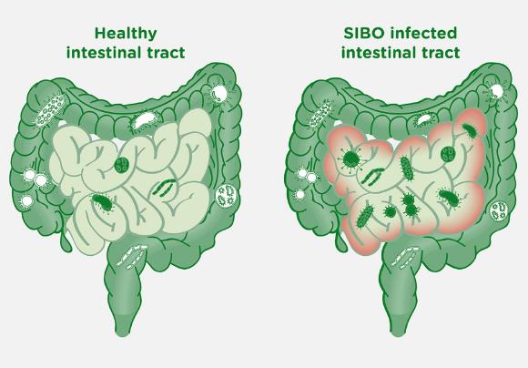 ?小腸細菌過度生長易復發(fā)或與腸動力障礙有關