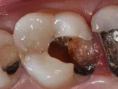 口腔微生物與唇腭裂及唇腭裂患者易感疾病有何關(guān)聯(lián)（二）