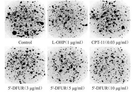 膠滴腫瘤藥敏檢測技術(shù)檢測及評(píng)價(jià)不同藥物濃度的5'-DFUR對(duì)胃癌的療效（二）