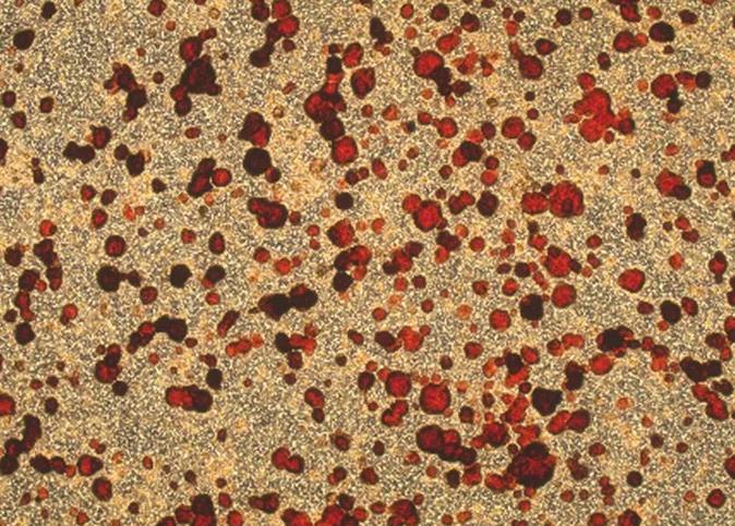 膠滴腫瘤藥敏檢測技術(shù)檢測及評(píng)價(jià)不同藥物濃度的5'-DFUR對(duì)胃癌的療效（一）