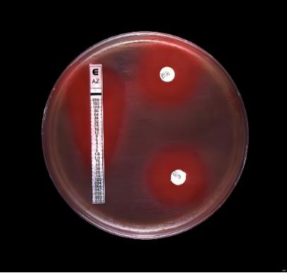 高通量藥敏檢測指導兒童急性白血病個體化治療的初步探索——摘要、資料與方法